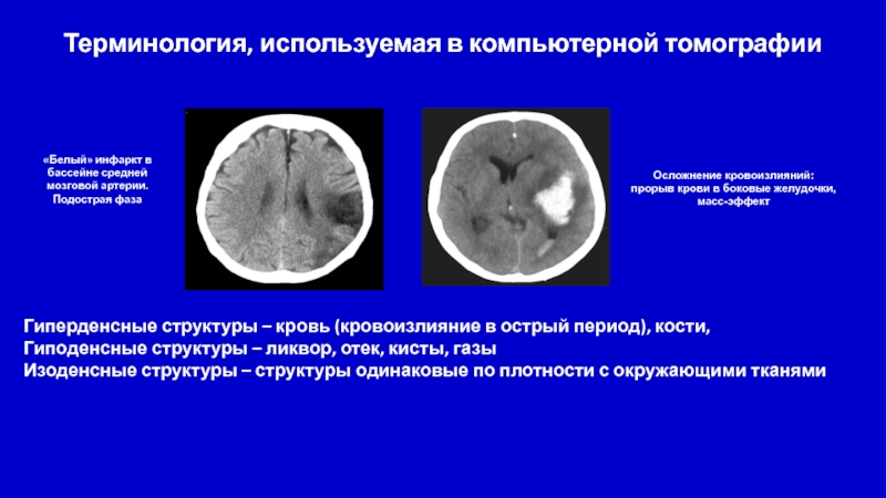 Кисты желудочков