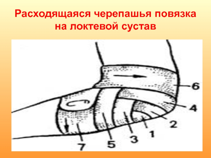 Черепашья расходящаяся повязка на коленный сустав