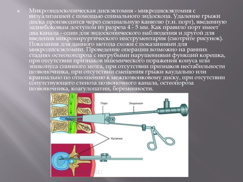 Микродискэктомия грыжи позвоночника. Микроэндоскопическая дискэктомия. Удаление грыжи микродискэктомия. Дискэктомия этапы операции. Этапы операции дискэктомия поясничного.