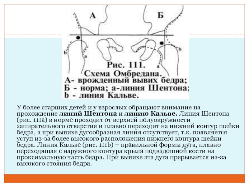 Схема врожденного вывиха бедра