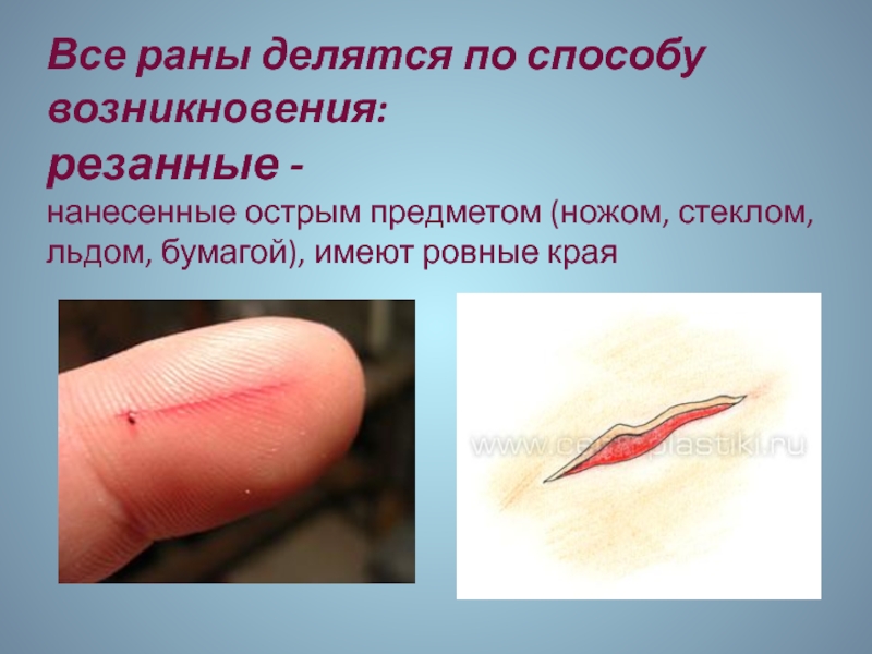 Все раны делятся по способу возникновения: резанные - нанесенные острым предметом (ножом, стеклом, льдом, бумагой), имеют ровные