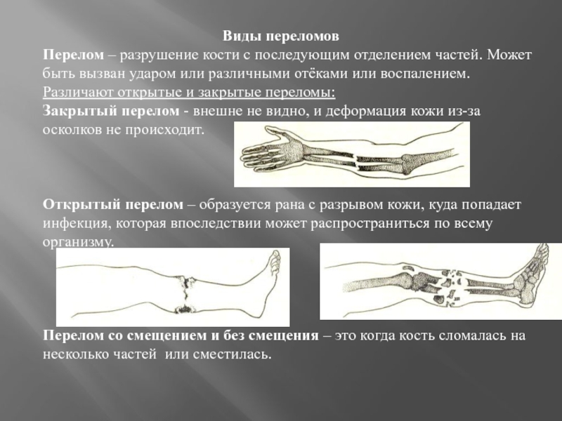 Закрытый перелом костей. По степени разрушения кости переломы могут быть …. Переломы костей закрытый открытый. Открытый и закрытый перелом кости. Открытый и закрытый перелом разница.