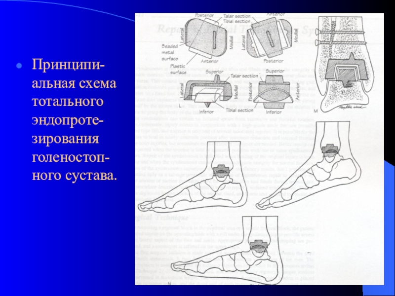 Схема голеностопа. Карточки по артрологии. Принципи. Презентація на тему "принципи тривимірної навігації".