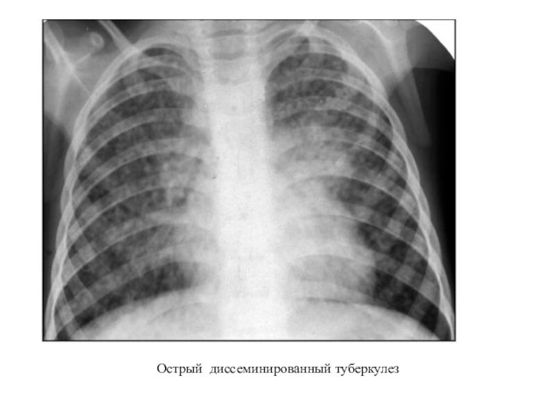 Диссеминированный туберкулез легких картинки