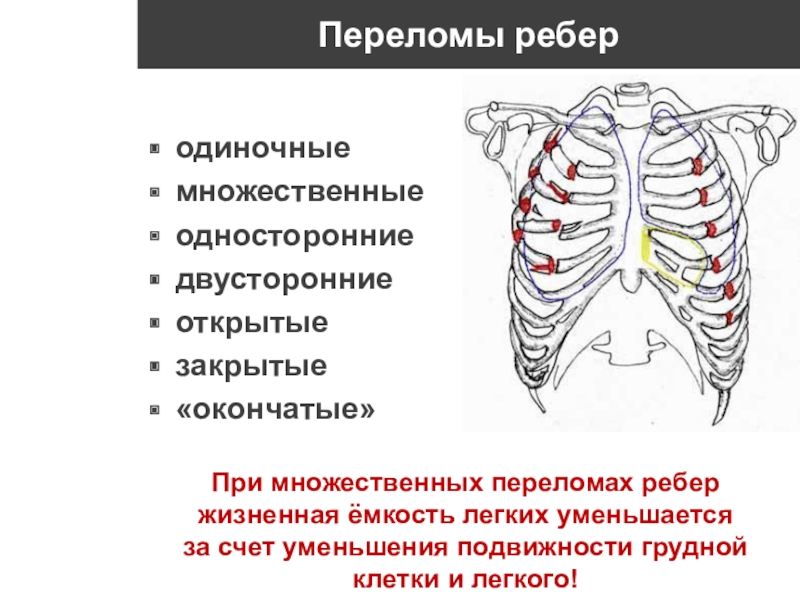 Сломаны ли ребра. Заднеаксиллярный перелом ребер. Переломы ребер классификация. Окончатый перелом ребер. Перелом ребра по среднеаксилярной линии.