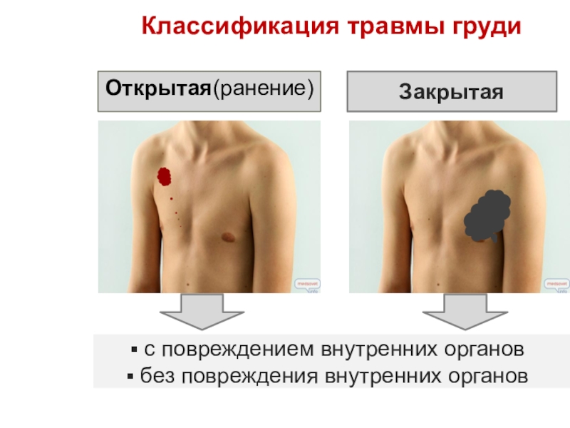 Травма груди. Открытые и закрытые повреждения груди. Повреждение молочной железы.