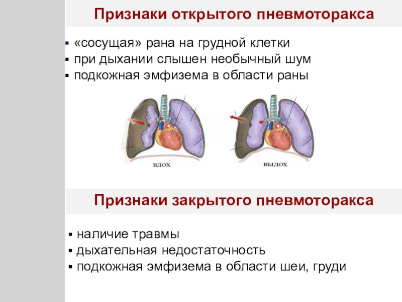 Травмы грудной клетки презентация