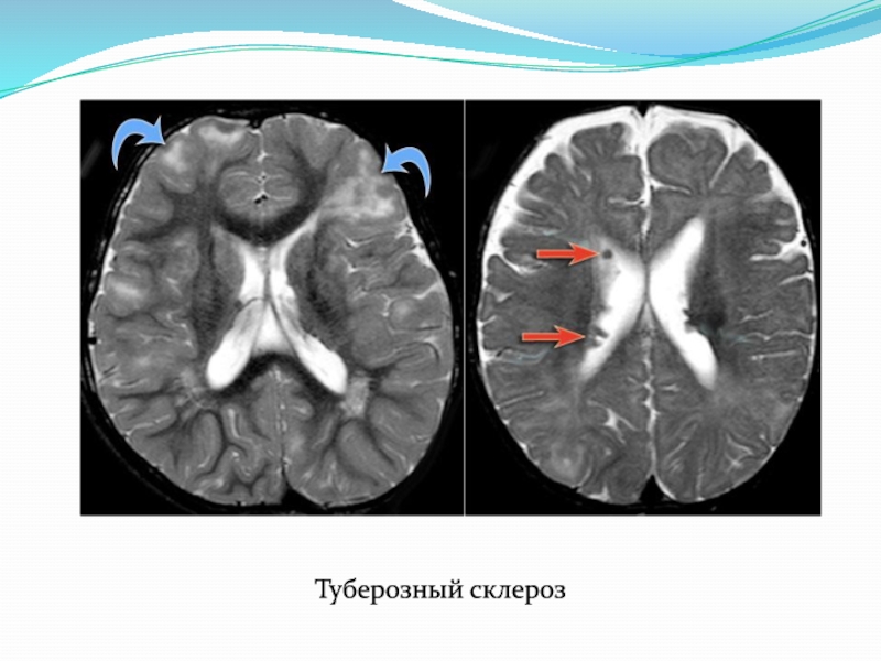 Туберозный склероз презентация