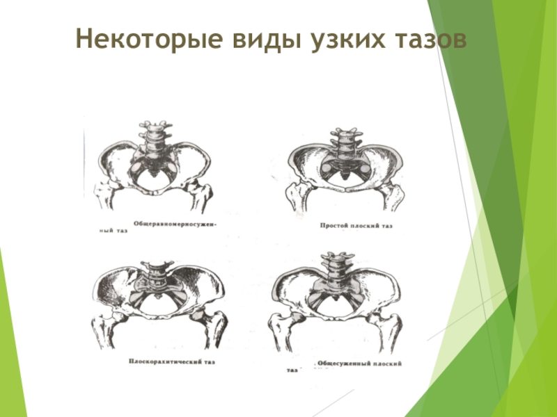 Клинический узкий таз презентация