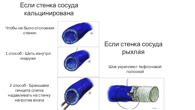 Как укрепить сосуды в организме. Что укрепляет стенки сосудов. Укрепление сосудистой стенки. Методы укрепления сосудистой стенки. Укрепить стенки сосудов носа.