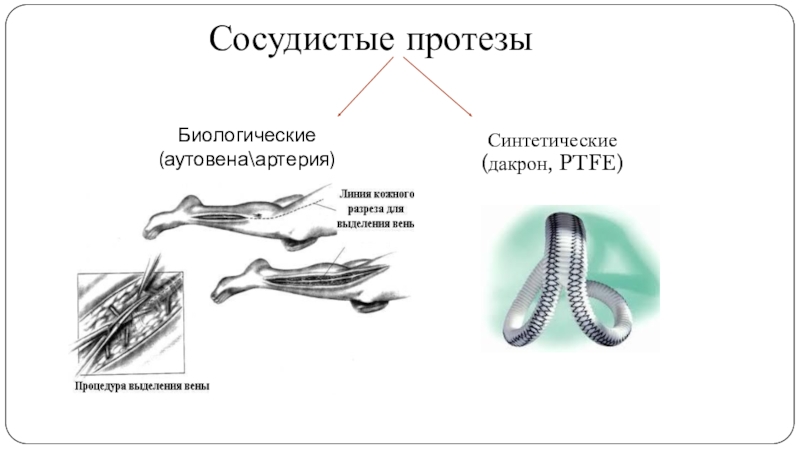 Протезирование сосудов презентация