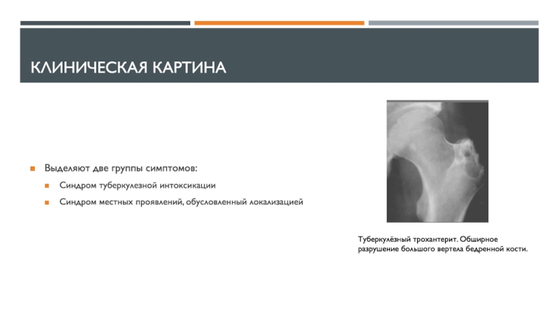 Саркомы костей клинические рекомендации тест нмо. Туберкулез костей и суставов. Опухоль бедренной кости симптомы. Туберкулез костей клиническая картина. Синдром большого вертела.