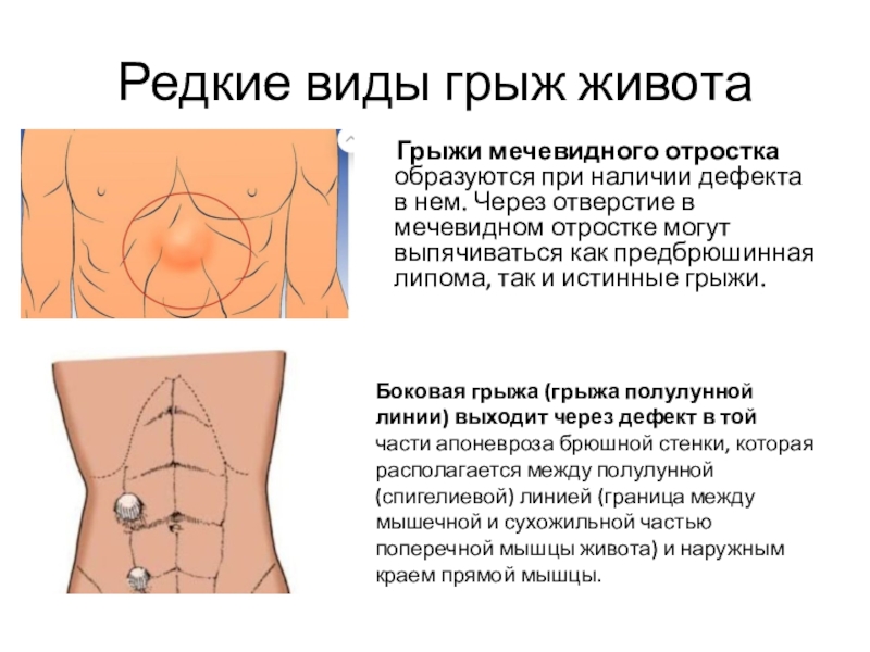 Массаж грыжи живота. Предбрюшинная липома белой линии живота. Грыжf мечевидного отростка.