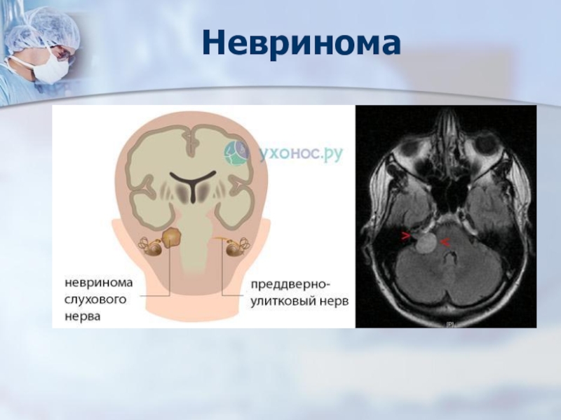 Невринома слухового нерва презентация