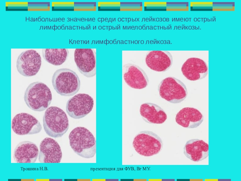 Лимфобластный лейкоз. Острый лимфобластный и миелобластный лейкоз. Отличие лимфобластного от миелобластного лейкоза. Морфология клеток миелобластный лейкоз. Острый лимфобластный лейкоз и миелобластный лейкоз отличия.