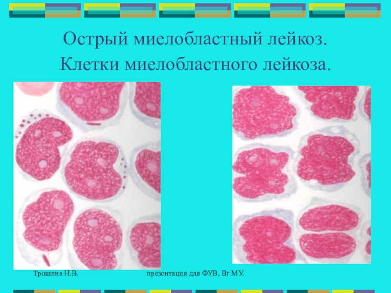 Лечение миелобластного лейкоза. Острый миелобластный лейкоз. Острый миелобластный лейкоз презентация. Морфология клеток миелобластный лейкоз. Морфологические особенности лейкозных клеток.