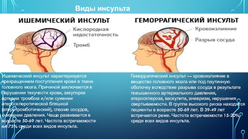 Инсульт правая сторона мозга последствия. Тромботический ишемический инсульт. Ишемический инсульт головного мозга. Артериальный ишемический инсульт.