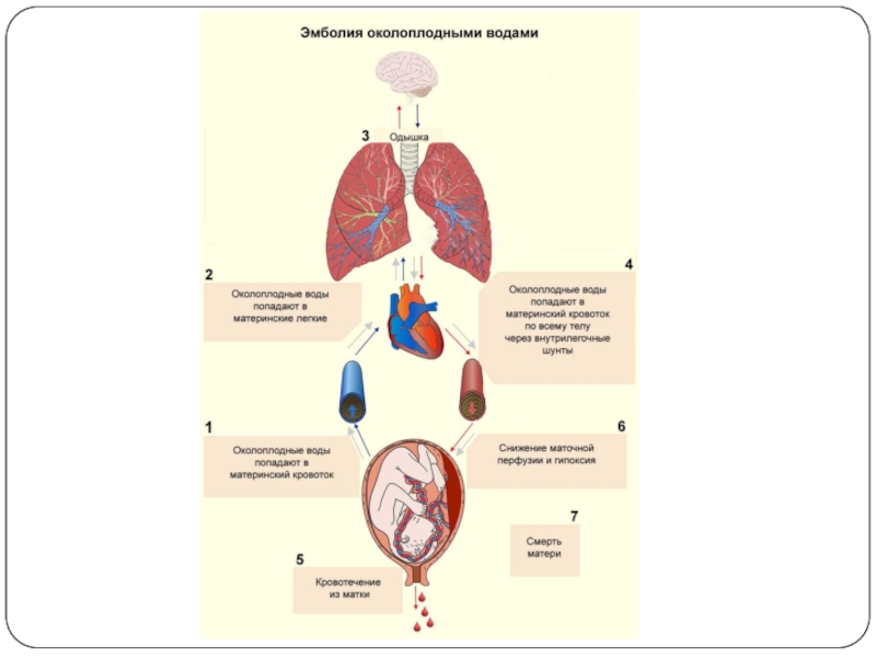 Эмболия околоплодными водами презентация