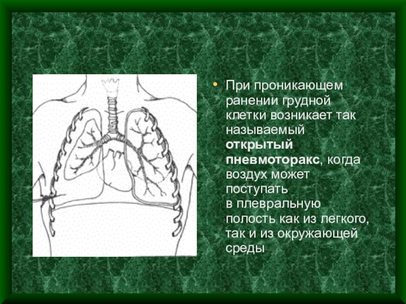 Проникающая рана грудной клетки карта вызова - 92 фото