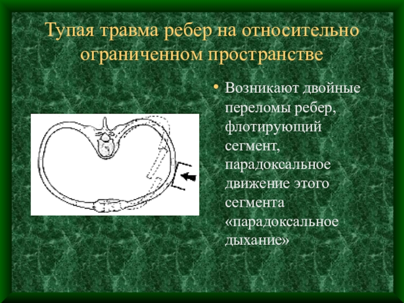 Травма груди презентация