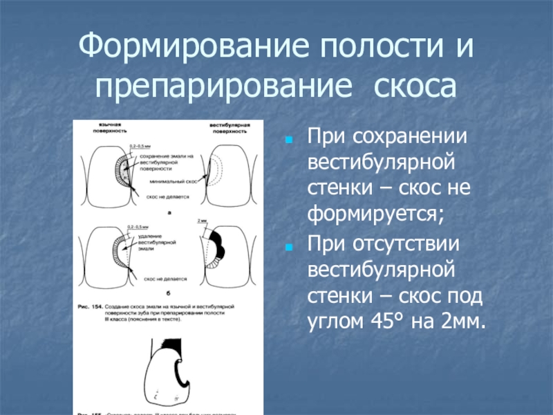 Полость причина. Основные этапы препарирования. Формирование полости. Ошибки при формировании кариозной полости. Ошибки при препарировании кариозных полостей.