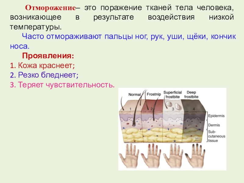 Патогенез отморожения схема