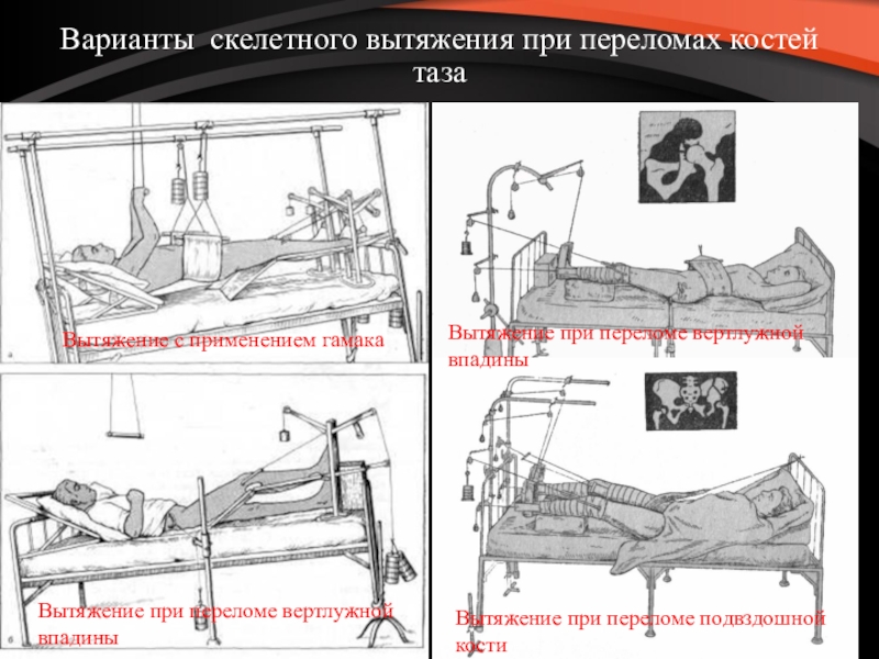 Лечение переломов костей. Скелетное вытяжение костей таза. Скелетное вытяжение нижней конечности. Скелетное вытяжение при переломе вертлужной впадины. Скелетное вытяжение при переломе костей таза.