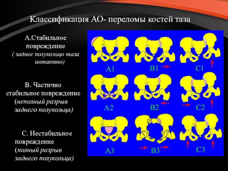 Переломы таза травматология презентация