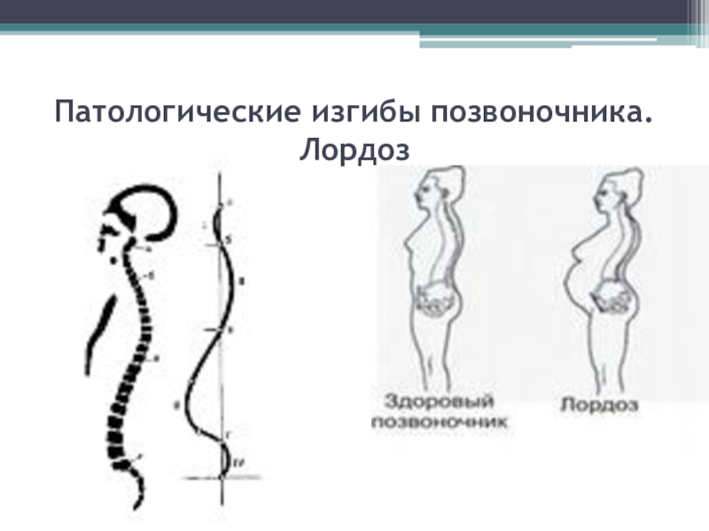 Физиологический изгиб позвоночника выпуклостью кзади называется. Патологические изгибы позвоночника. Физиологические и патологические изгибы позвоночника. Патологический лордоз. Патологические изгибы позвоночника человека.