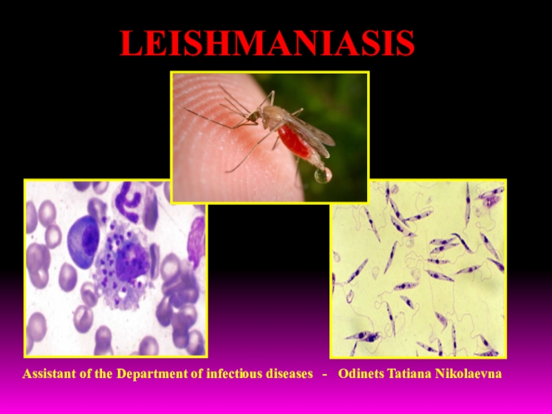 LEISHMANIASIS
Assistant of the Department of infectious diseases - Odinets