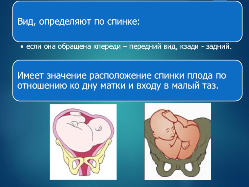 Косое и поперечное положение плода презентация