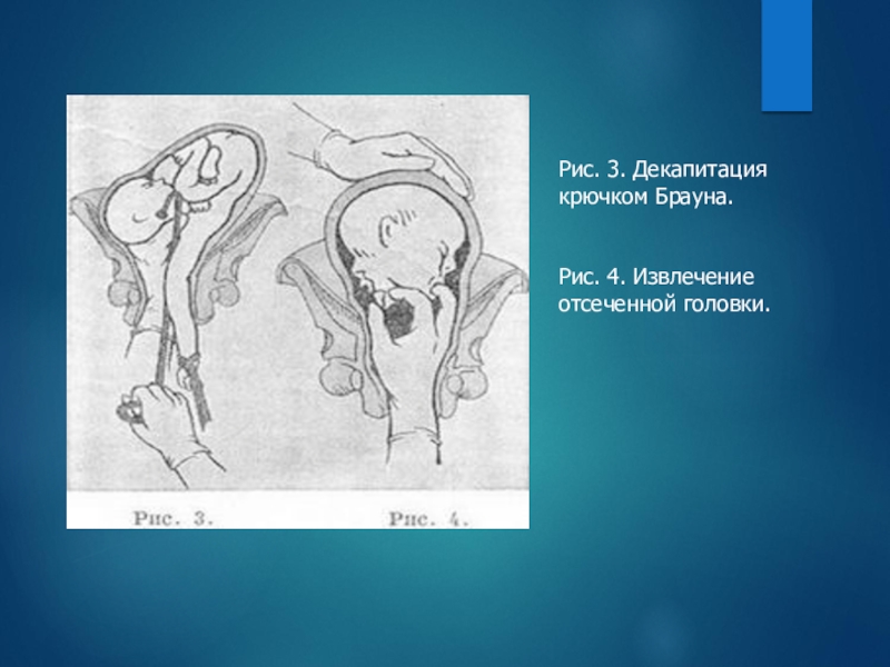 Косое и поперечное положение плода презентация