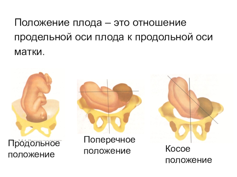 Неправильное положение плода картинки