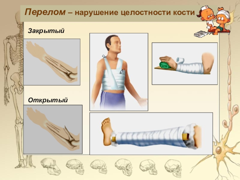 Перелом картинка для презентации