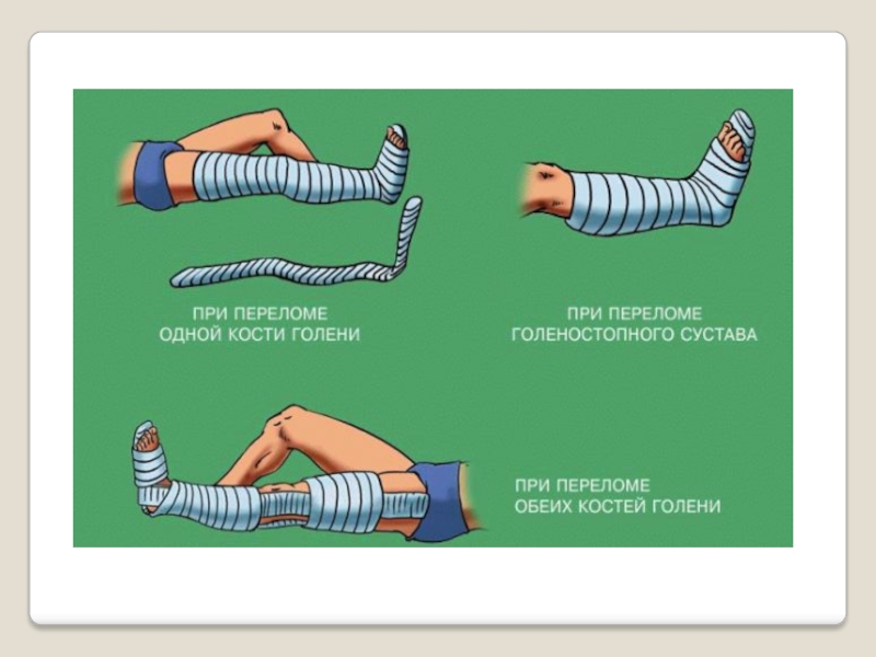 Проект по обж первая помощь при переломах