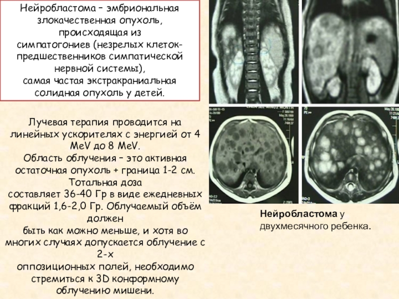 Нейробластома у детей презентация