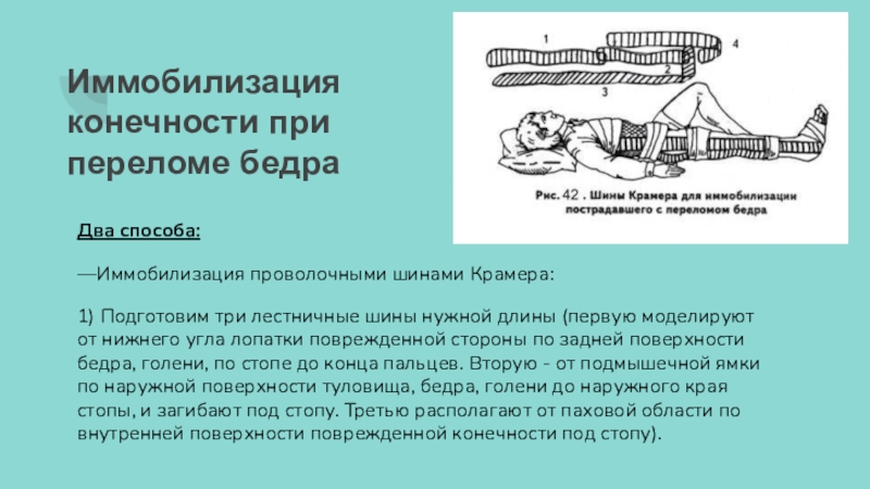 Наложение шины на сломанную конечность. Иммобилизация конечности. Иммобилизация конечности при переломе. Способы иммобилизации при переломах конечностей. Шина Крамера при переломе голени.