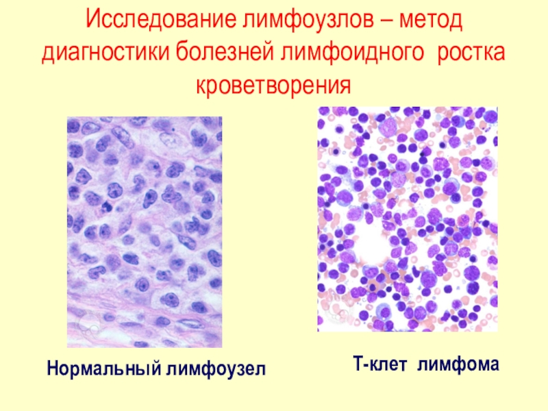 Цитологическая картина лимфомы ходжкина