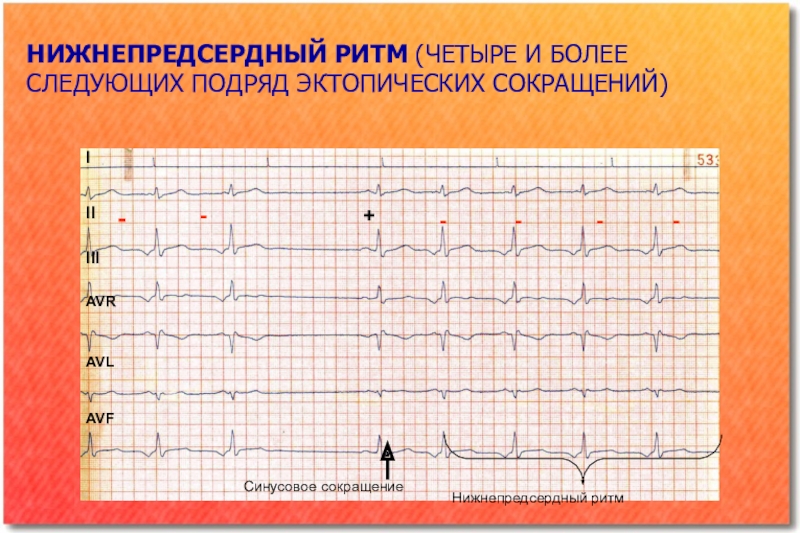 Ритм синусовый что это значит. Нижнепредсердный ритм. Регулярный синусовый ритм. Ритм синусовый нерегулярный. Ускоренный синусовый ритм.