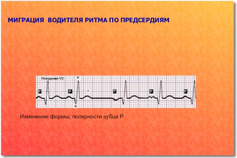 Ритм проводимости. Нарушение водителя ритма. Полярность зубца р. Как определить полярность зубца р.