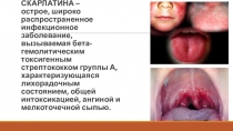 СКАРЛАТИНА – острое, широко распространенное инфекционное заболевание,