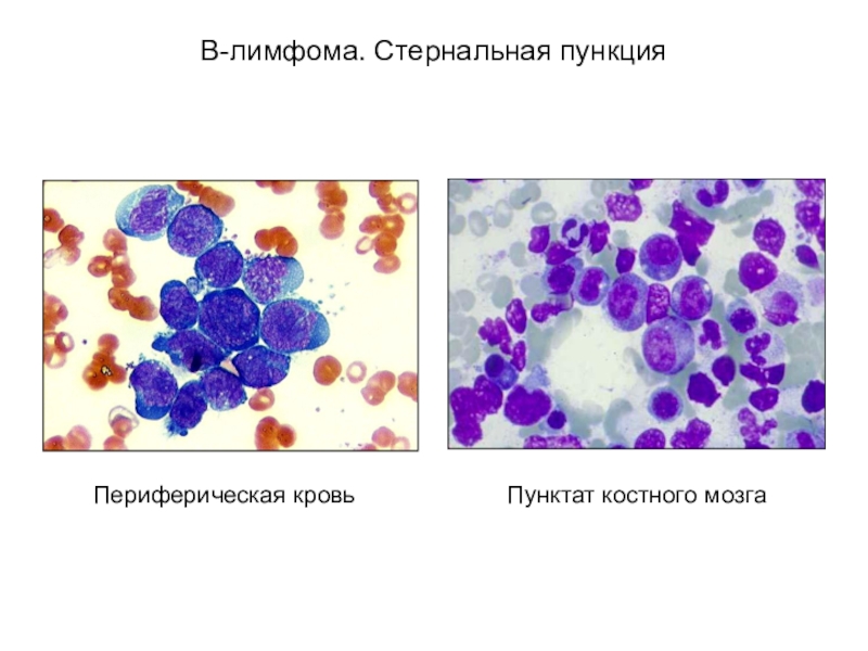 Пункция костного мозга картинки