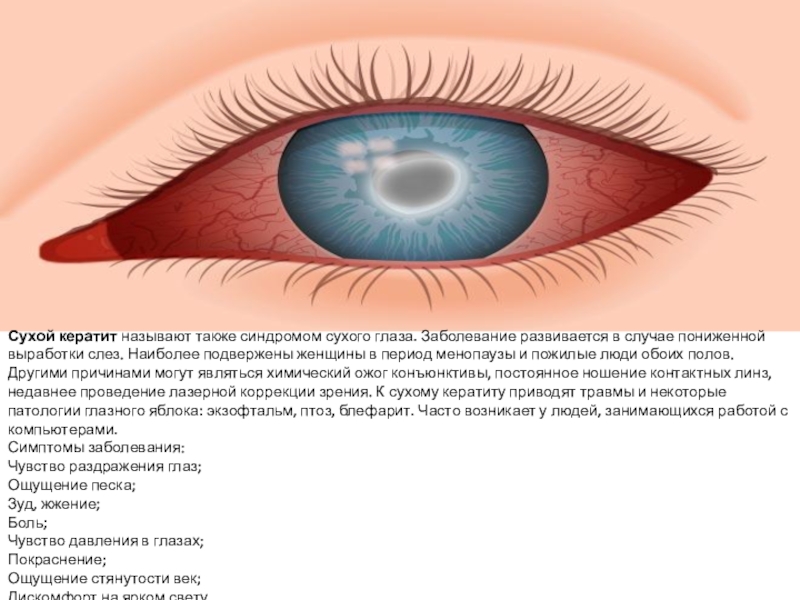 Вирусное заболевание глаз. Краевой кератит роговицы. Кератит кератоконъюнктивит. Кератит, конъюнктивит, увеит). Воспаление роговицы кератит.