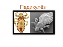 Педикулёз