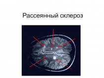 Рассеянный склероз