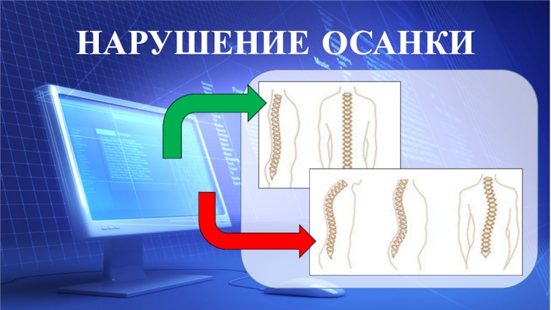 Презентация НАРУШЕНИЕ ОСАНКИ