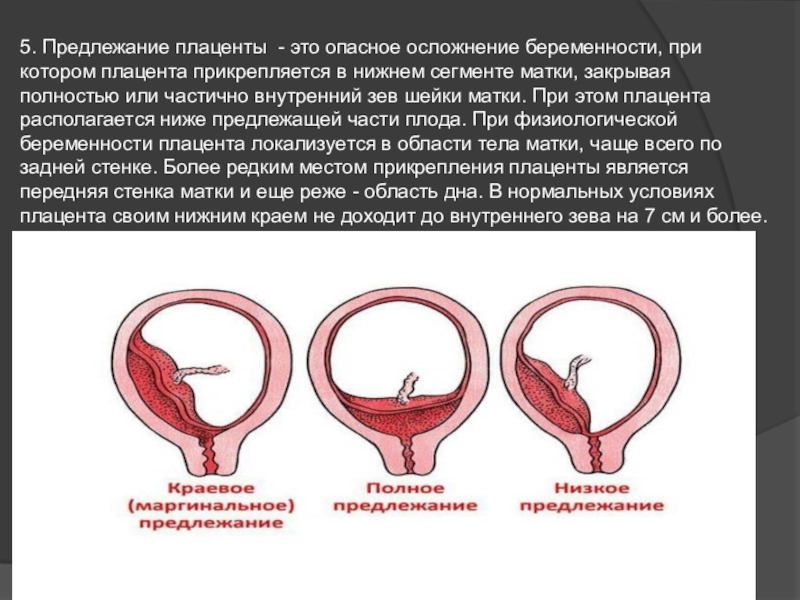 Зев шейки матки закрыт. Классификация предлежания плаценты, краевое. Центральное боковое и краевое предлежание плаценты. Внутреннего зева при беременности. Предлежание плаценты внутренний зев.