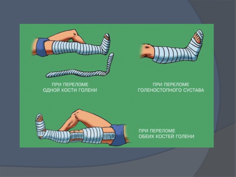 Презентация про переломы