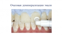 Очаговая деминерализация эмали