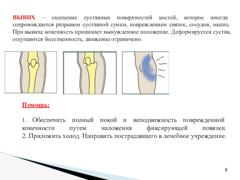 Первое вывихивающее движение при удалении. Вынужденное положение конечности. Положение ноги при вывихе. Вывих с изменением длины конечности.